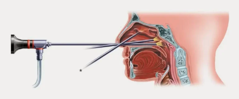 Эндоскопия лор органов