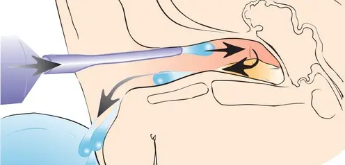 Промывание слухового прохода